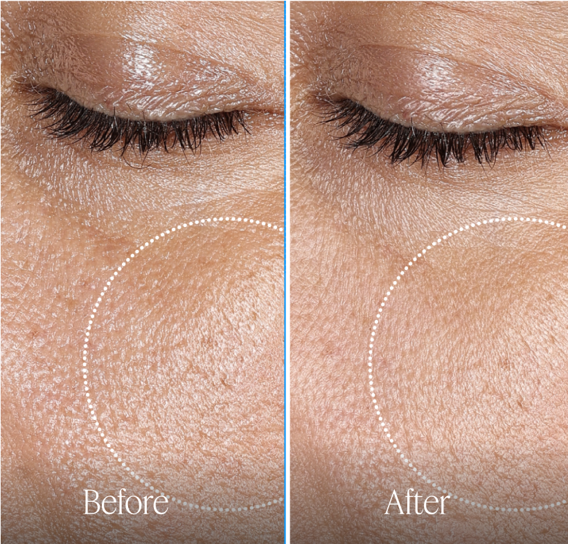Before and after comparison of eye area skin texture on a person's face.