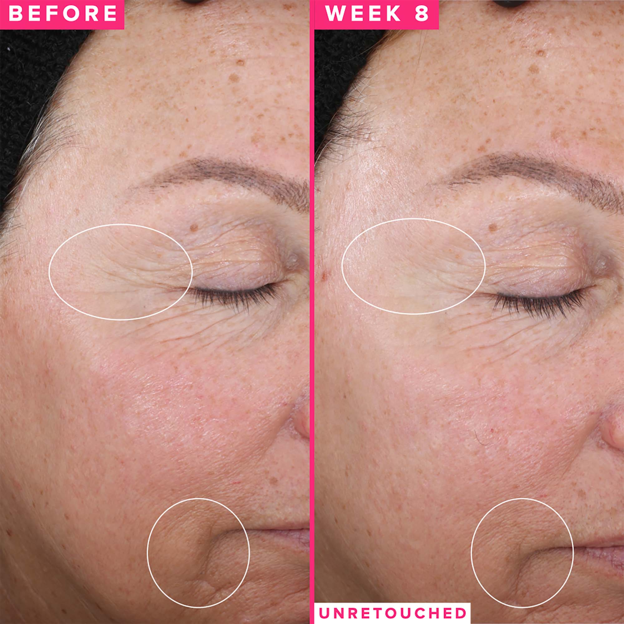 Before and after picture of crow's feet on a woman after using Farmacy 1% Vitamin A Retinol Serum for 8 weeks